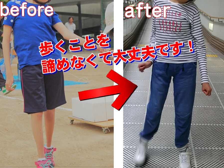 重度の側弯症や障害があっても、代償動作を抑え、歪みを改善する運動で歩行力が回復した